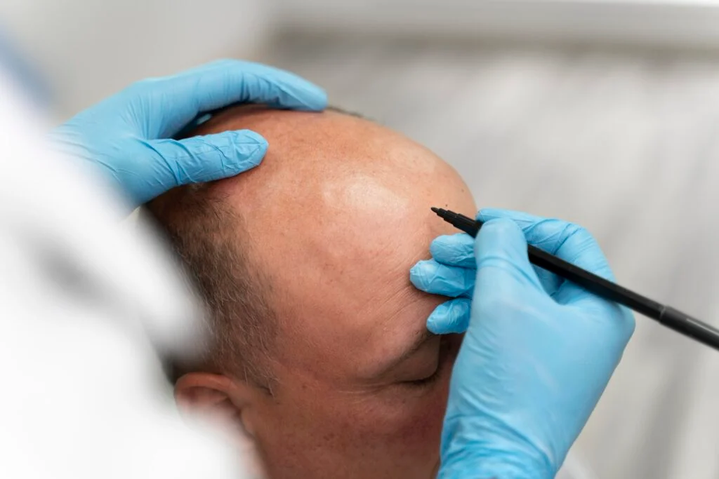 The Future of Hair Transplant in Turkey: DHI vs FUE Techniques