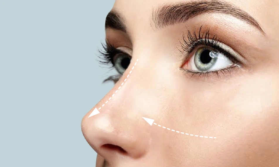 Rhinoplasty in Turkey: Ultrasonic Nose Job, Top Surgeons & Recovery Guide